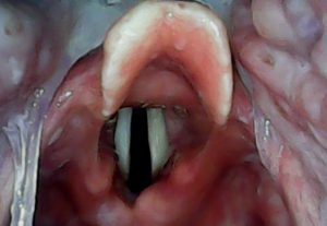 ویوی-ویدیو-لارنگوسکوپ-سانیار-از-حنجره-و-ووکال-کورد